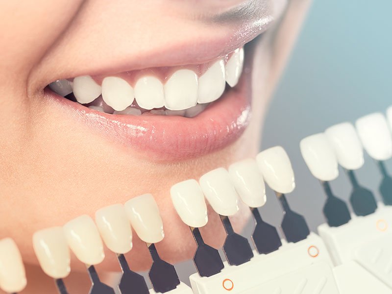 Gum Lift / Gum Contoring cityName Transform Your Smile with a Gum Lift