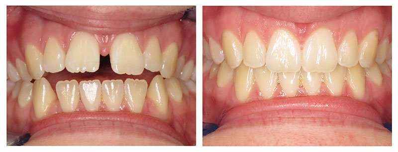 bonding | enameloplasty | century smile dental