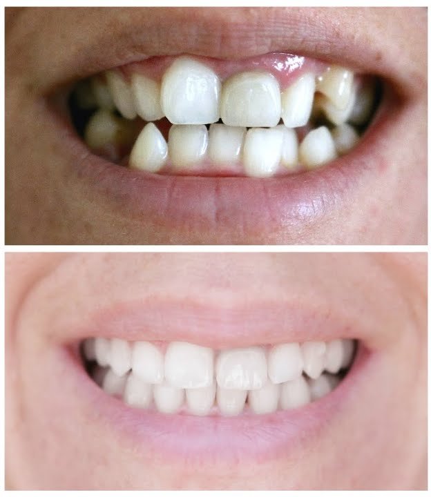 Before & After Dental Crowns | Century Smile Dental Practice | Culver City, CA