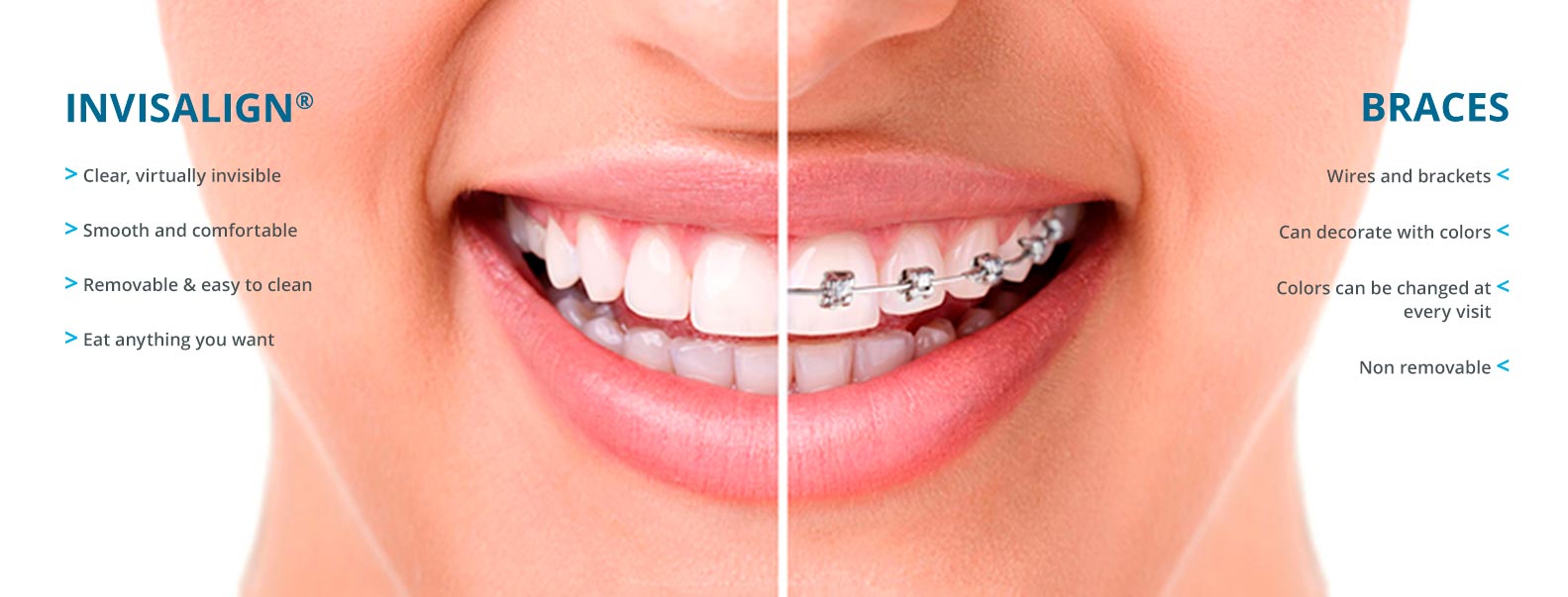 Invisalign Or Braces: Which Is Better? - Sbenati Dentistry