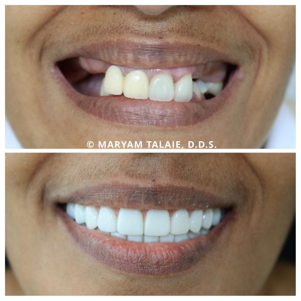 Maryam Talaie d.d.s. | Dental Implants | G4byGolpa