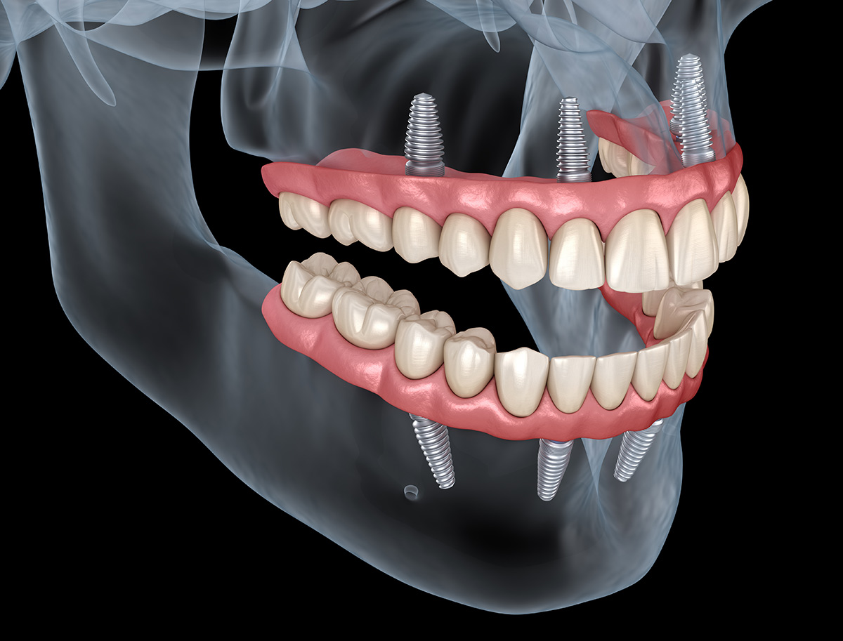 All On 4 Dental Implants - Culver City
