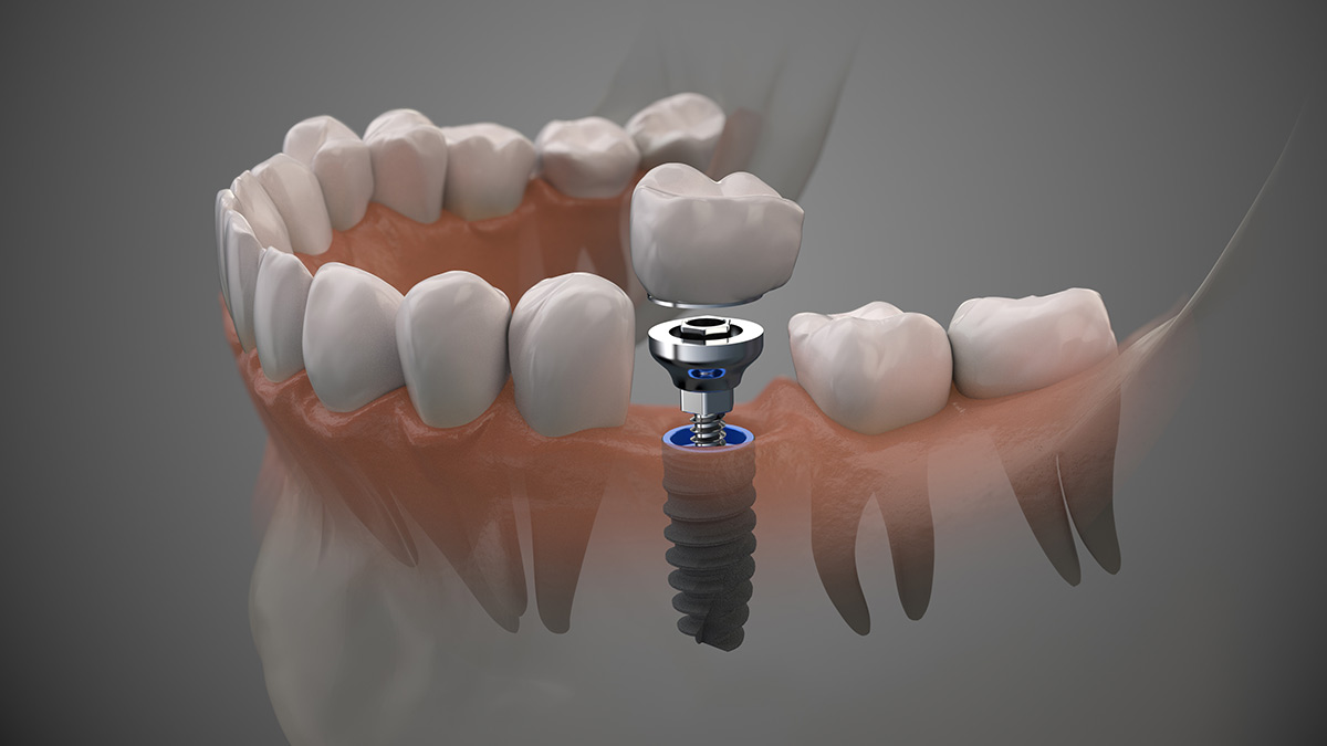 Dental Implant Illustration - Century Smile Dental - Culver City, CA