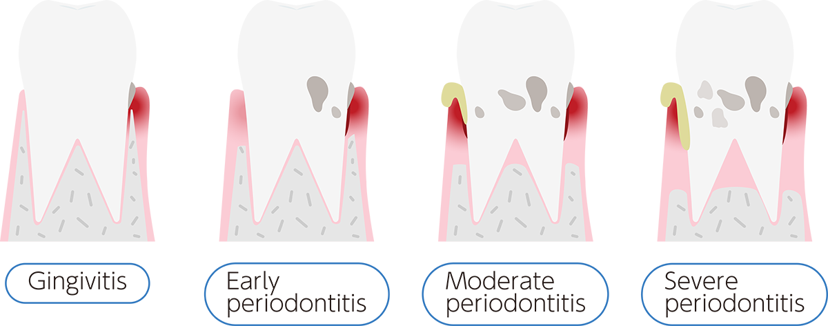 Stages of Periodontal Disease - Dental Implants - Century Smile Dental - Culver City, CA