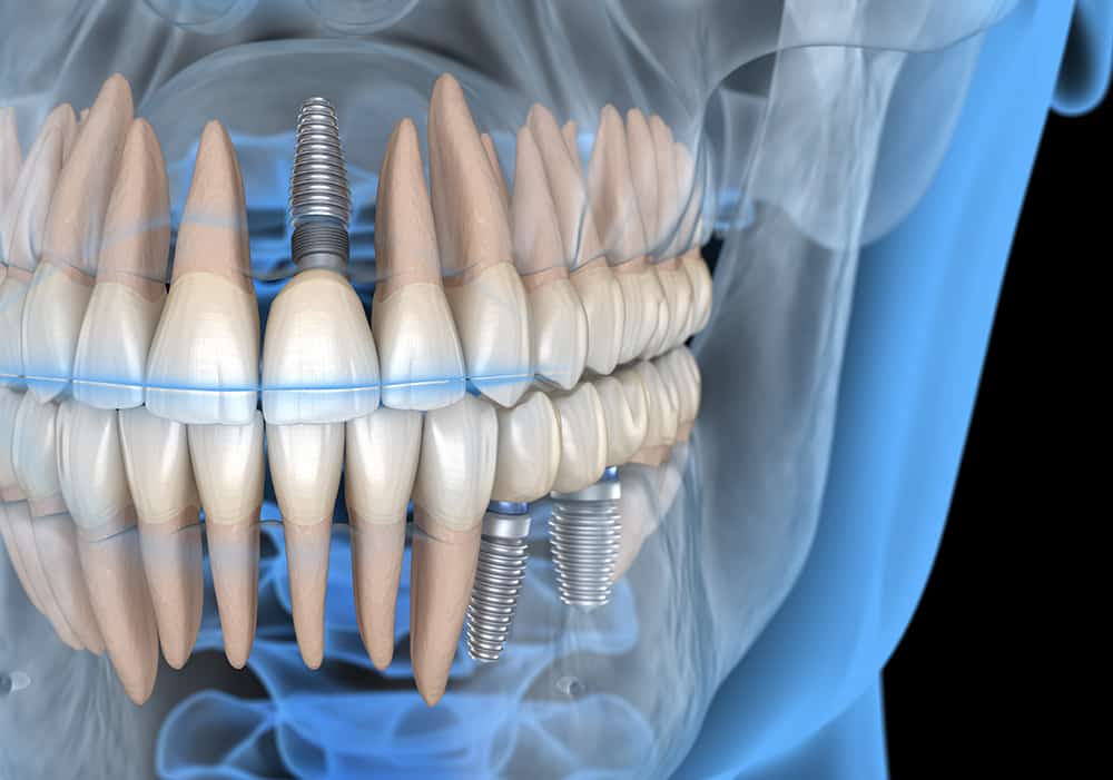 Endosteal Implants - Century Smile Dental - Culver City, CA