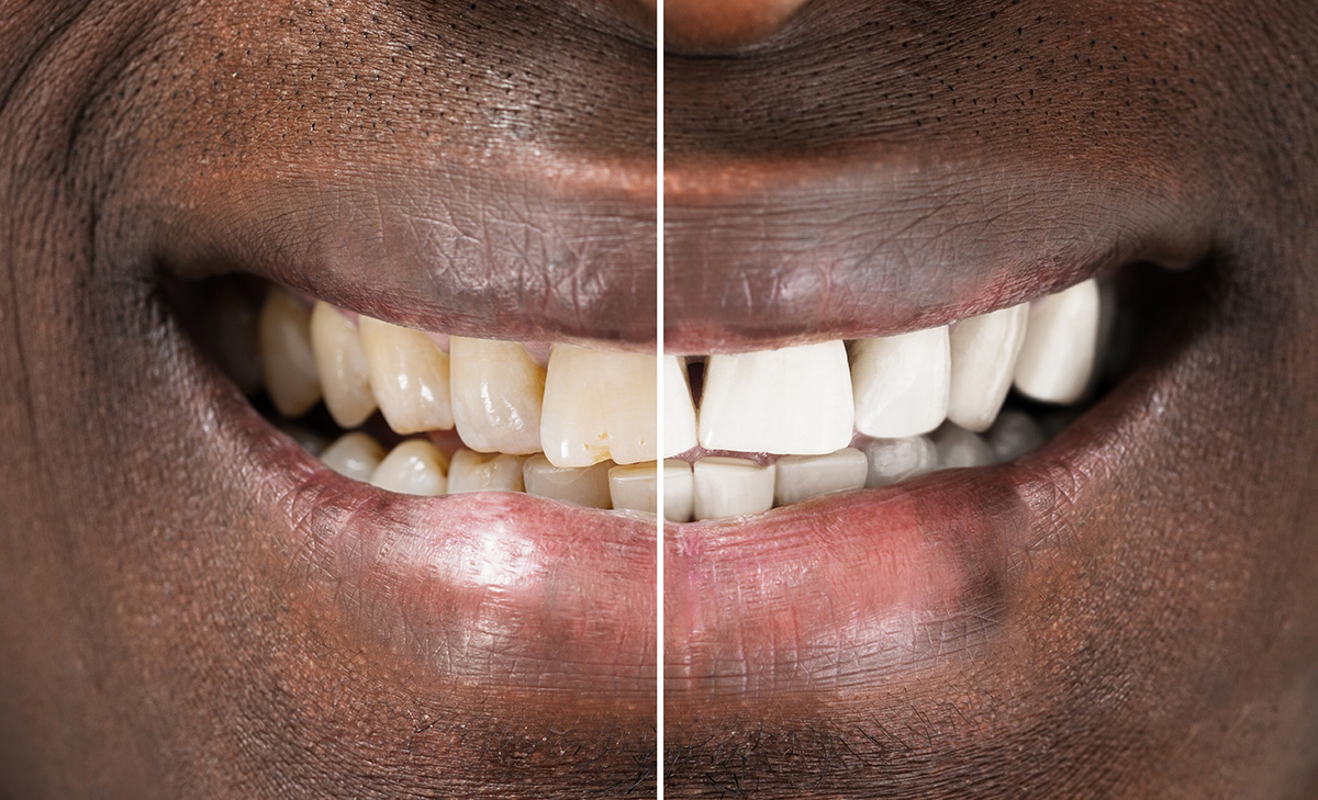 Zoom Whitening Before and After