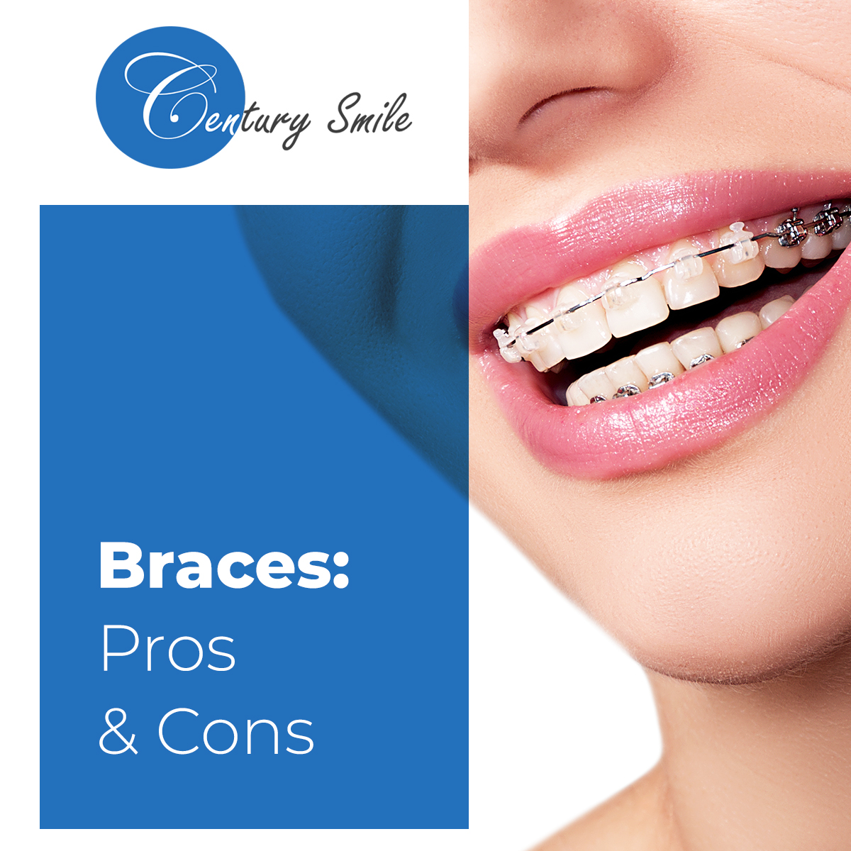 Braces Pros and Cons - Century Smile Dental - Culver City, Century City