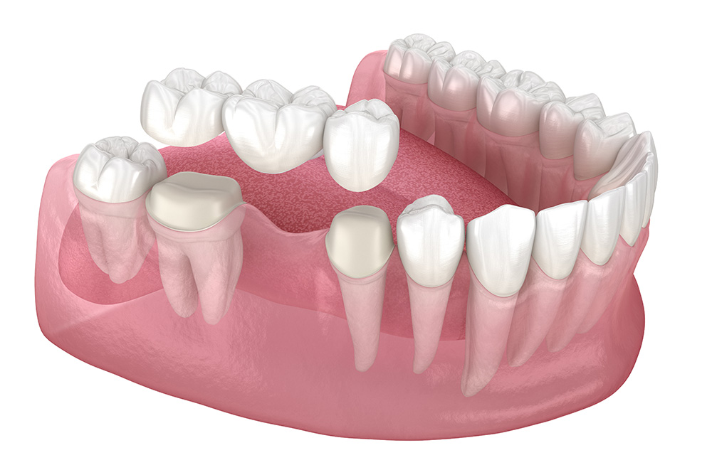 Dental Bridge - Century Smile Dental - Culver City
