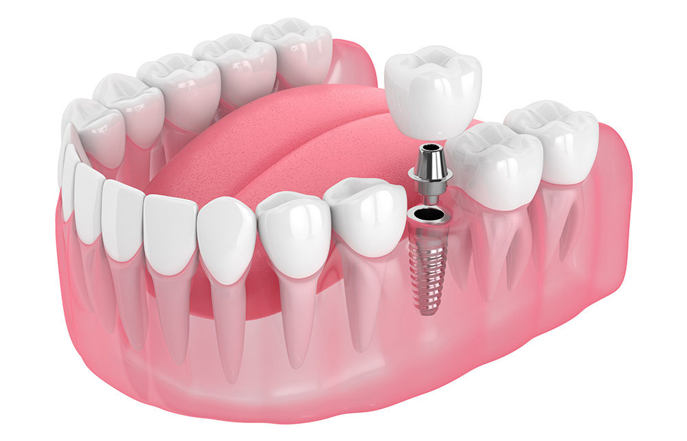 Dental Implant or Dental Implants - Century Smile Dental - Culver City