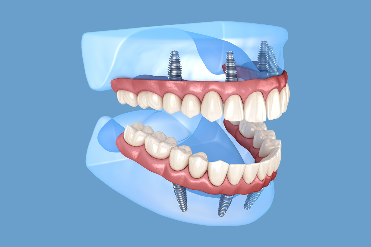 All On 4 Dental Implants - Century Smile Dental - Culver City