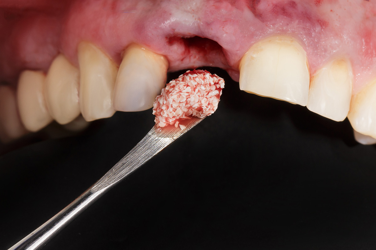 Bone Graft - Artificial bone - Century Smile Dental - Culver City