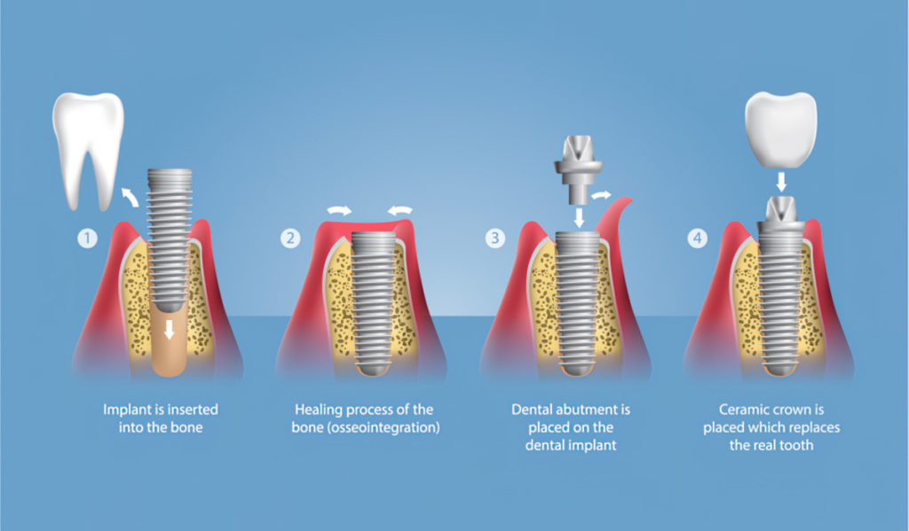 Dental Implants Process - Century Smile Dental - Culver City