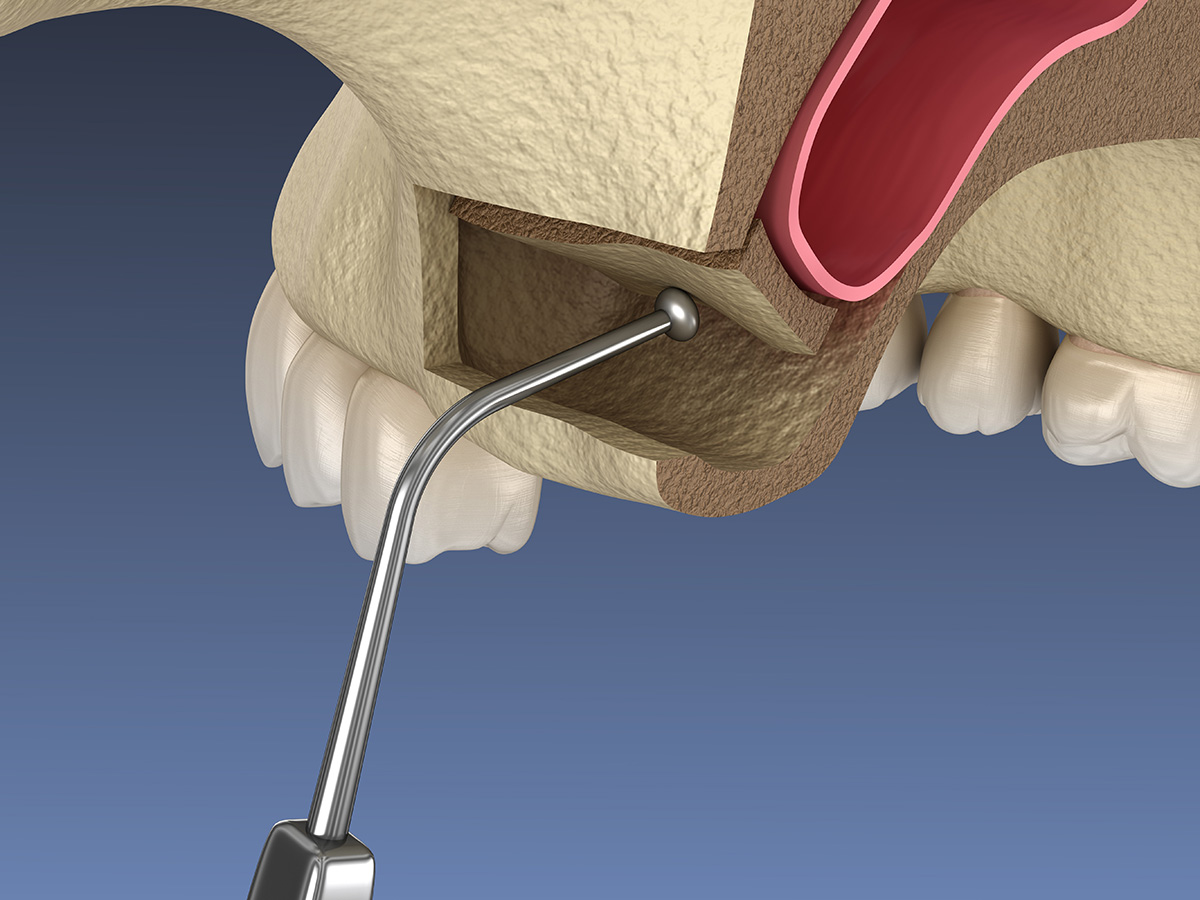 Sinus Lift - Dental Implants - Century Smile Dental - Culver City