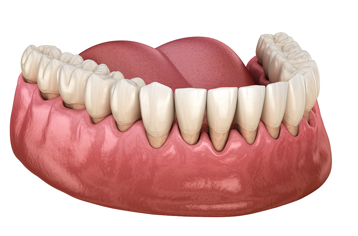 Gum Recession - Tooth Sensitivity - Century Smile Dental - Culver City, CA
