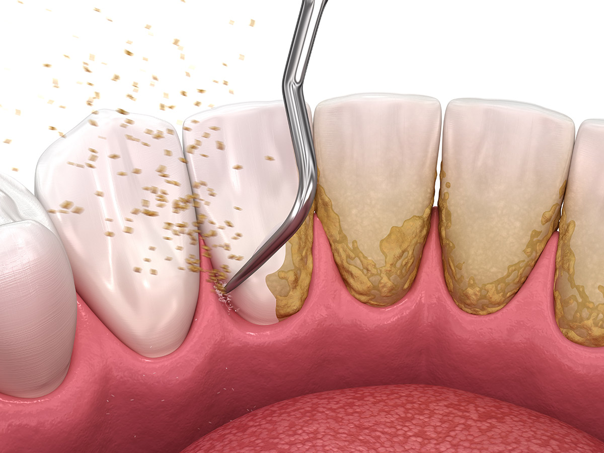 Dental scaling and root planing
