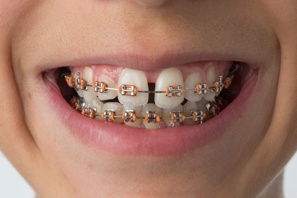 Braces or Invisalign - Century Smile Dental - Culver City, CA