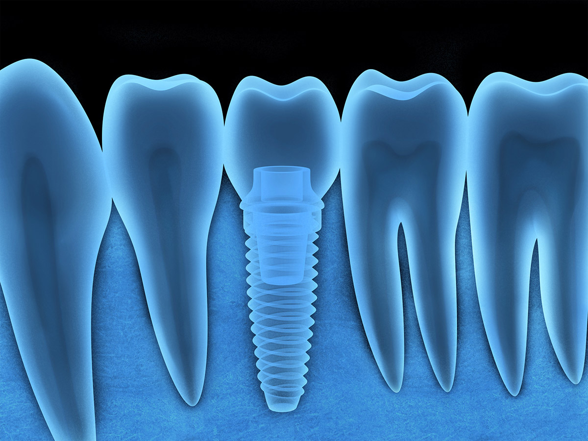 Dental Implant - Century Smile Dental - Culver City, CA