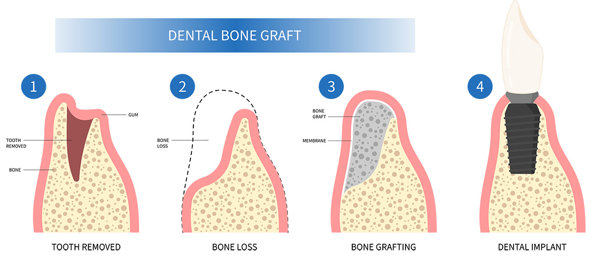 Bone Graft for insufficient bone