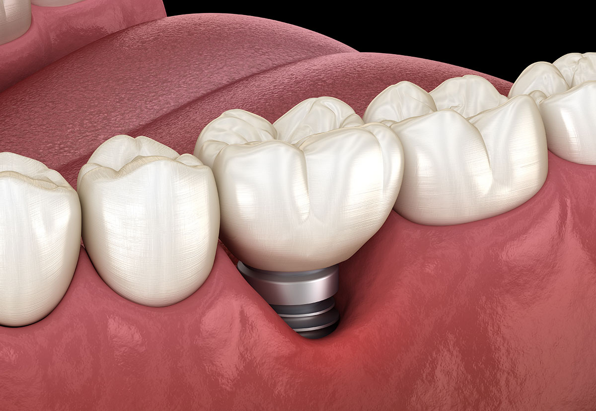 What are the signs of dental implant failure?