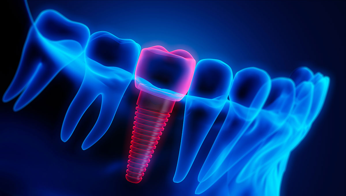 What are the signs of dental implant failure?