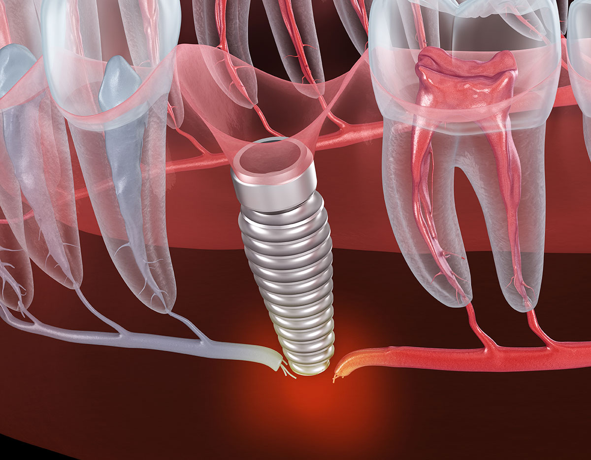 What are the signs of dental implant failure? - Century Smile Dental - Culver City, CA