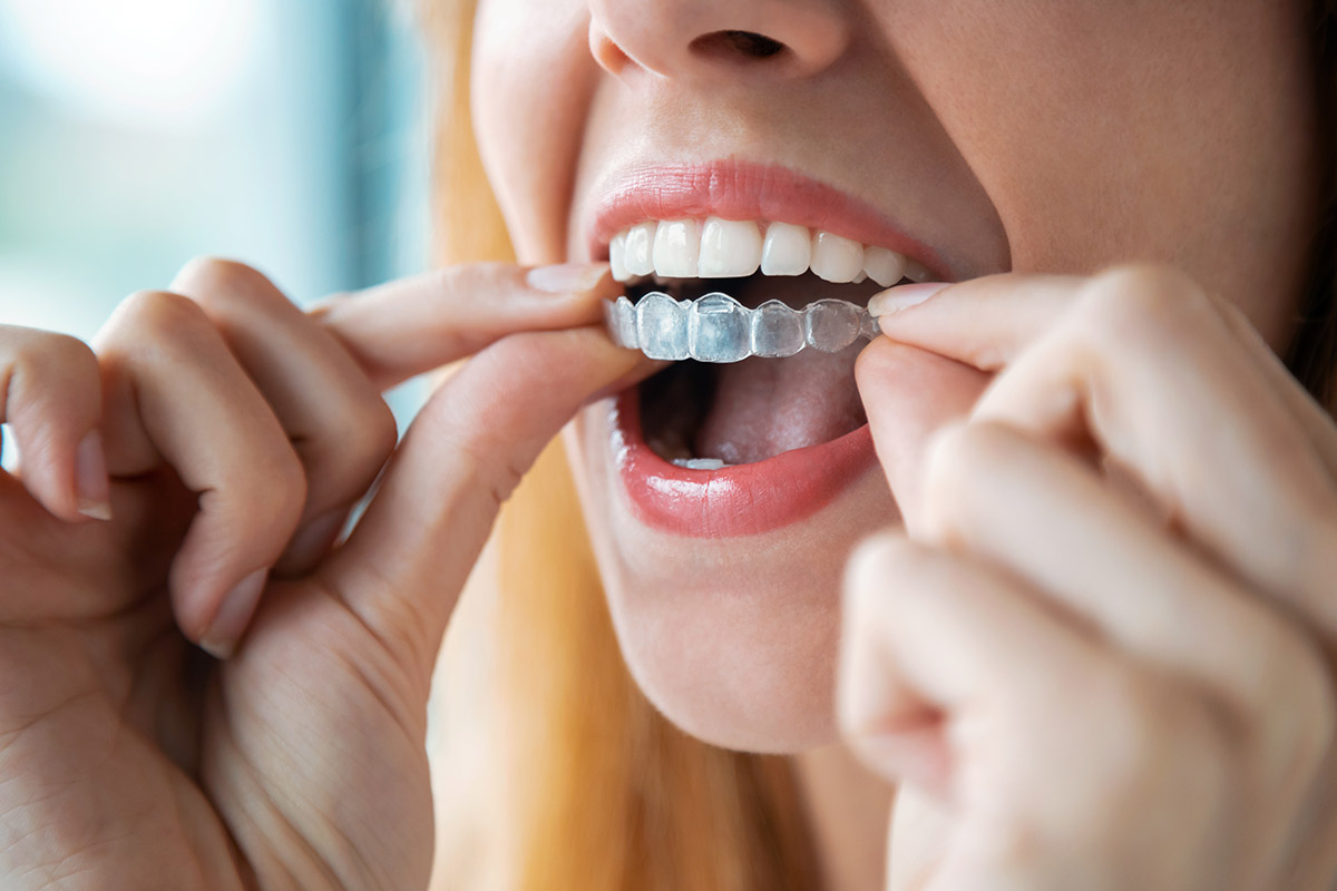 How Long Does Invisalign Take - Century Smile Dental - Culver City, CA
